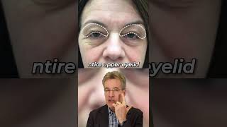 Brow Lift VS Blepharoplasty  browlift eyelift eyes [upl. by Lraep]