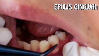 EPULIS GINGIVAL [upl. by Giavani]