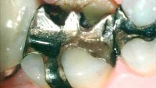 Cracked Filling tooth needs a crown Delray Beach Dentist [upl. by Brade39]