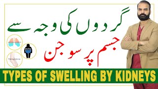 Types of Swelling by Kidneys Understand the Difference 【Edema in HindiUrdu】 [upl. by Kiele]