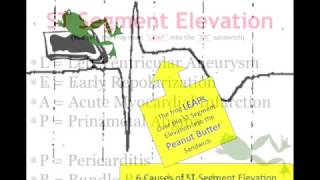 Teaching 12 Lead EKG STEMI or early repol [upl. by Susan794]