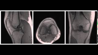 UTEDESS High Isotropic Resolution MRI [upl. by Anomor]