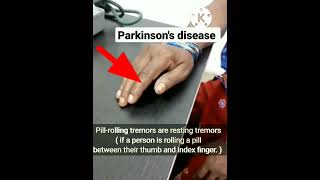 Pillrolling Tremors Parkinsons Disease [upl. by Anastase]