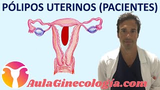 PÓLIPOS UTERINOS PACIENTES Síntomas diagnóstico y tratamiento  Ginecología y Obstetricia [upl. by Rann4]