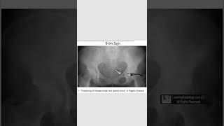 Brim signpagets diseaseradiology orthopedics revision neetpg inicet fmge [upl. by Peckham]