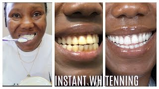 How I whitened my yellow teeth in 2 Minutes  LIVE DEMO HOME REMEDY [upl. by Pierrette104]