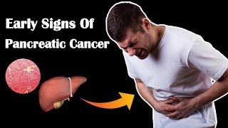 7 Early Signs Of Pancreatic Cancer  Pancreatic Cancer Symptoms In Men and Women [upl. by Aitnis]