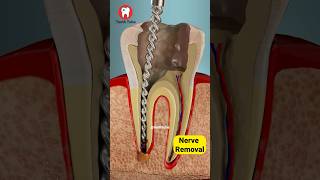 Root Canal Treatment 3D Animation shorts [upl. by Thomasine]