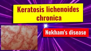 Keratosis lichenoides chronica overview causes features management [upl. by Eigna]