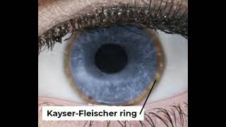 Fleischers ring and Vogts striae keratoconus cornea eyedoc ophthalmology [upl. by Anera]