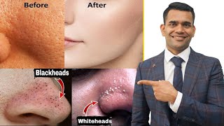 Blackheads Whiteheads Open Pores 100  Working Home Remedy  How To Shrink Pores [upl. by Lenora967]