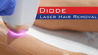 The Benefits of Diode Laser Hair Removal  The MediDiode [upl. by Raynold]