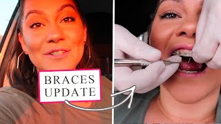 1 MONTH BRACES UPDATE  FIRST TIGHTENING VLOG  Bina Rae  Braces as an ADULT [upl. by Harman174]