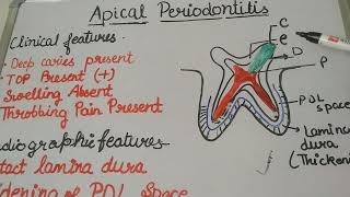 Apical periodontitissequalaeofpulpitis [upl. by Annahoj]