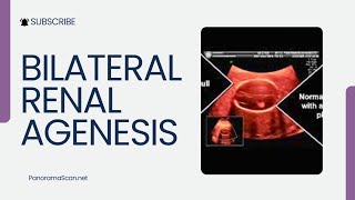 Bilateral Renal Agenesis [upl. by Donnell]