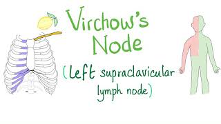 Virchows Node Left Supraclavicular Lymph Node  Cancer  Oncology [upl. by Blithe]