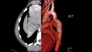 КТ грудной клетки коарктация аорты [upl. by Raasch]
