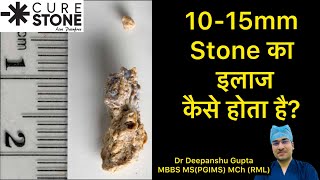 1015mm Kidney Stone का इलाज कैसे होता है Treatment for 1015 mm Kidney stones In Hindi [upl. by Aihseuqal]