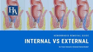 Internal Vs External Hemorrhoids  Do I have Internal or External Hemorrhoids [upl. by Melany]