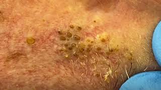 Big Cystic Acne Blackheads Extraction Blackheads amp Milia Whiteheads Removal Pimple Popping 015 [upl. by Aipotu]