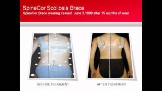 SpineCor Scoliosis Brace Patient Case Study [upl. by Yrod]