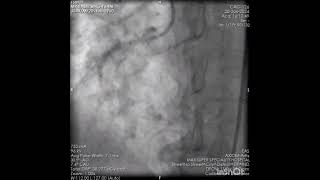 PCI to RCA Instent severly calcified CTO [upl. by Johnsten910]