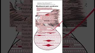 Myofascial pain syndrome [upl. by Colis163]