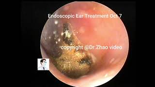 Reexamination and fungal treatment of cholesteatoma [upl. by Noreen]