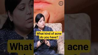 Hormonal Acne Treatment acne skincare dermatologist shorts [upl. by Enawd]