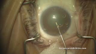 Single Incision Cataract Surgery 266 [upl. by Myrlene]