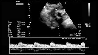 8 weeks fetal heart rate  ultrasound [upl. by Wilona]