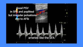 Peripheral artery disease PAD with atrial fibrillation ultrasound color and spectral Doppler [upl. by Hnoj259]