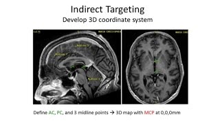 Deep Brain Stimulation  You Asked For It [upl. by Rednasela]