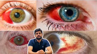 Subconjunctival hemorrhage eye blood education optometry drhashimjabbar subcribemychannel [upl. by Ihskaneem]