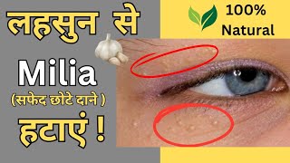 Milia Removal  आँखों के नीचे सफेद दाने हटाने का असान उपाय  Natural Home Remedy [upl. by Ronnie826]