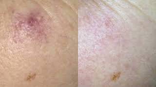 Cherry Angioma removal quick and easy with NDyag laser technology [upl. by Danita]