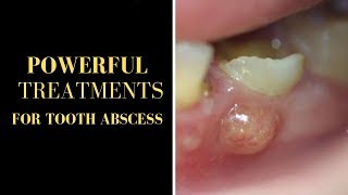 Tooth Abscess Treatment GOLDEN TECHNIQUE TO CURE TOOTH ABSCESS NATURALLY IN RECORD TIME [upl. by Ydnamron922]