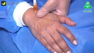 HAND REJUVENATION BY ELLANSE FILLER  PCL Filler by SINCLAIR [upl. by Ardekal]