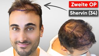 Shervins zweite Haartransplantation  Erfahrung VLOG [upl. by Conrad698]