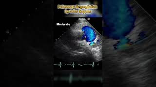 Pulmonary Valve Insufficiency estimation by color doppler Echocardiography [upl. by Katine]