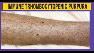 ITP  Immune Thrombocytopenic Purpura [upl. by Livesay179]