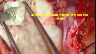 Brain tumorCEREBELLAR DERMOIDmicrosurgical removaldr suresh duganiHUBLIKARNATAKINDIA [upl. by Ramedlaw314]