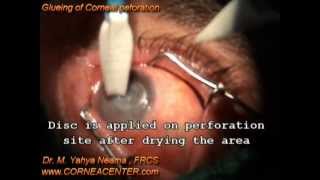 glueing corneal perforation [upl. by Imefulo92]