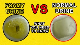 Foamy Urine vs Normal Urine What is the difference and causes [upl. by Heyer]