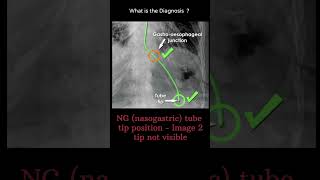 NG nasogastrictube tip position Image 2 tip visible 182 chest Xray tubes radiologychannel007 [upl. by Niatsirhc]