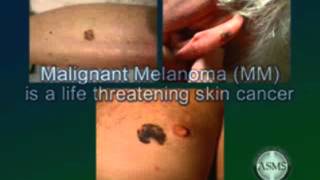 Skin cancer types basal cell squamous cell carcinoma malignant melanoma causes prevention Miami [upl. by Bower658]