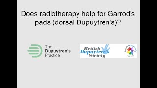 RT1 Radiotherapy for Garrods pads [upl. by Eybbob323]