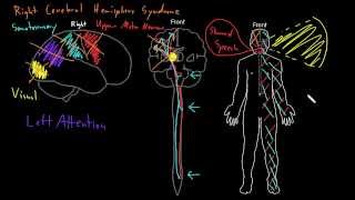 Syndrome Right cerebral hemisphere syndromes [upl. by Lulu752]