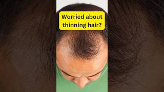 Male Pattern Baldness hairloss haircare minoxidil finasteride menshealth hairlosstreatment [upl. by Sanders]