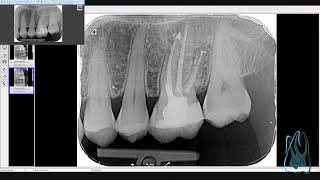 LIVE endodontic retreatment First Upper left molar [upl. by Krys]